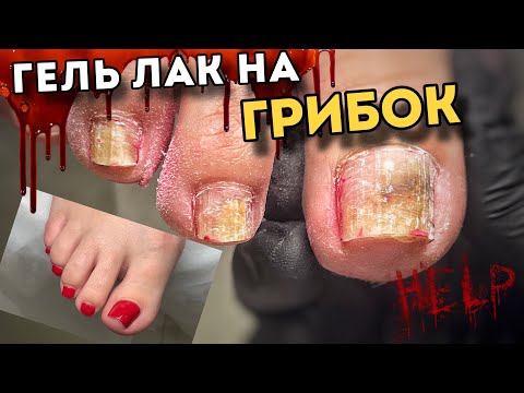 Видео: Заражение через кисточку гель лак | скрывала чтобы другие не знали о грибке #подологтатьянапак
