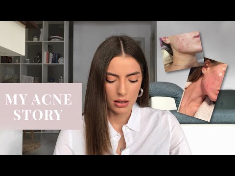 Видео: Како ги излечив акните | Roaccutane | Angela Gjorgieva