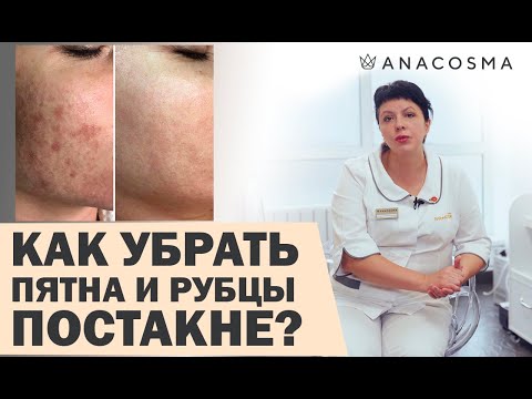 Видео: ПОСТАКНЕ 🔥 КАК УБРАТЬ ПЯТНА И РУБЦЫ ПОСЛЕ ВЫСЫПАНИЙ? | Федоряченко Оксана