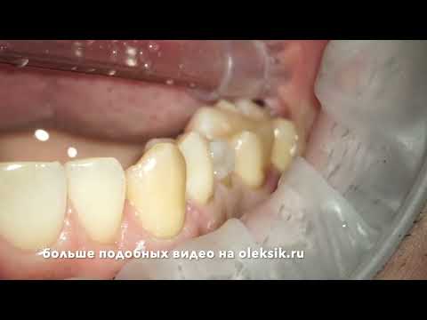 Видео: 15 зуб, препарирование,моделирование временной коронки версия для вк