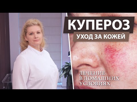 Видео: Лечение купероза на лице в домашних условиях. Купероз - что это?