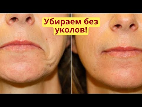 Видео: Опущенные уголки губ, морщины марионетки, кисетные морщины и носогубная морщина. Убираем все сразу!