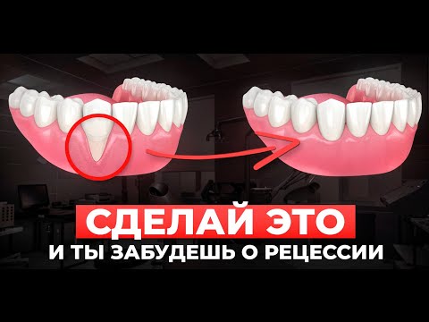 Видео: Просто невероятно: Лечение рецессии десны, которое возвращает десны на место!