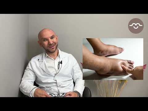 Видео: Загадочная болезнь - Липедема. Lipedema.