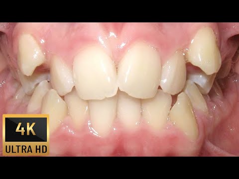 Видео: БЕЗЕКСТРАКЦИОННО лечение на криви кучешки зъби!