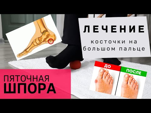 Видео: Косточка на большом пальце ноги и пяточная шпора. Самомассаж