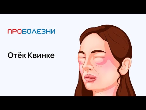 Видео: Отёк Квинке