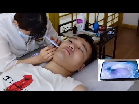 Видео: Первый опыт визуальной чистки ушей