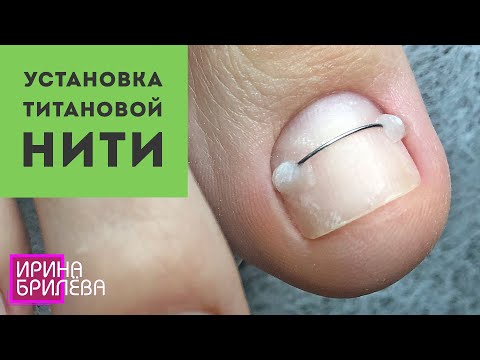 Видео: Титановая нить NiTi (Коррекционная система) 🌸 Педикюр 🌸 Ирина Брилёва