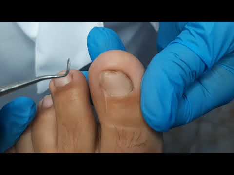 Видео: Установка титановой нити. Лечение вросшего ногтя - Подолог Сумы
