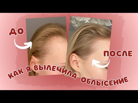 Видео: ВЫЛЕЧИЛА ОБЛЫСЕНИЕ ЗА 5 МЕСЯЦЕВ! МОЙ ОПЫТ