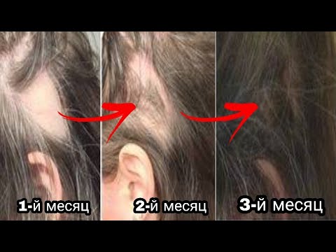 Видео: Новые волосы без сбривания оставшихся, быстрое решение при алопеции.