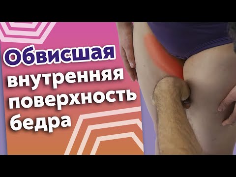 Видео: Что делать, если внутренняя поверхность бедра обвисла? / Как убрать целлюлит на бёдрах?