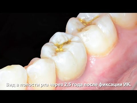 Видео: Удаление, одномоментная имплантация в области первого моляра нижней челюсти