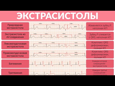 Видео: ЭКГ Разбор Экстрасистолы