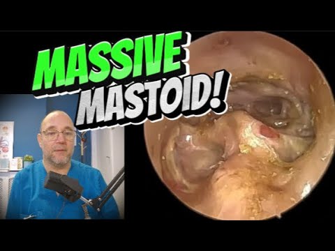 Видео: МАССИВНЫЙ СОСЦЕВИД! 373 #ухо #ушнаясера #удалениеушнойсеры #сосцевидныйотросток #удовлетворительн...