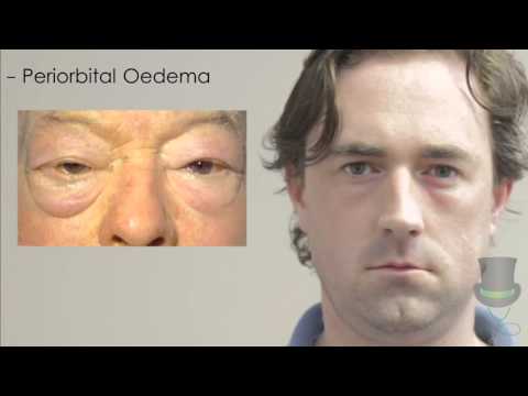 Видео: Обследование щитовидной железы