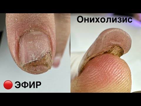 Видео: ОНИХОЛИЗИС.МАНИКЮР ОНЛАЙН. Виктория Авдеева