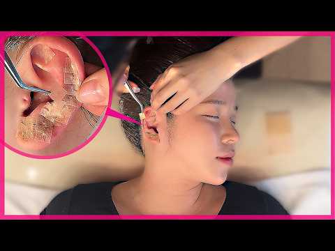 Видео: ASMR｜Корейская ушная терапия и массаж уха, Гуаша👂Вы заснете за 5 минут! 😴