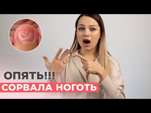 Видео: Я сорвала ноготь | Коррекция гелем самой себе