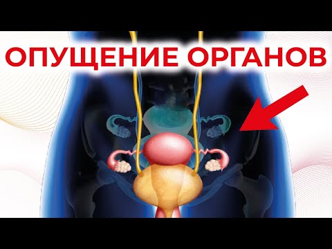 Видео: Опущение внутренних органов. Висцероптоз.