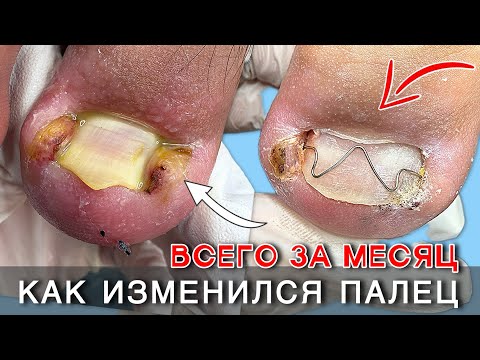 Видео: ШОКИРУЮЩЕЕ врастание ногтей