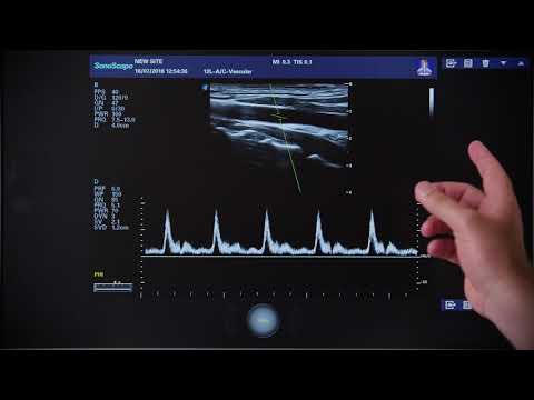 Видео: S40Exp 5 Импульсный допплер
