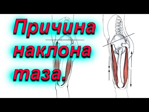 Видео: Причина наклона таза вперед.
