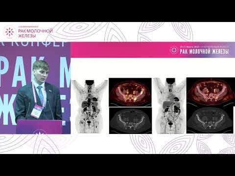 Видео: Как правильно интерпретировать результаты ПЭТ-КТ, оценка динамики, PERCIST