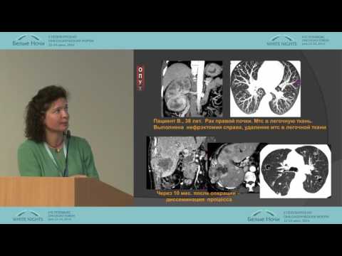 Видео: Лучевая диагностика опухолей почек