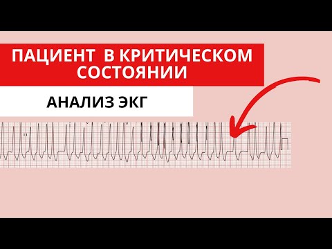 Видео: Пациент в критическом состоянии. Как анализировать ЭКГ?