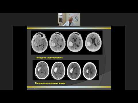 Видео: Внутримозговые и субарахноидальные кровоизлияния
