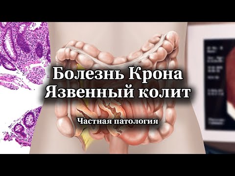 Видео: Болезнь Крона и язвенный колит | Частная патология