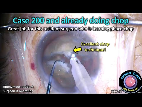 Видео: CataractCoach™ 2742: случай 200 и уже выполняется факоэмульсификация!