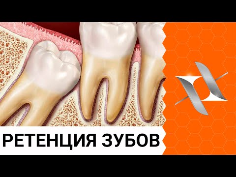 Видео: 6 причин почему зубы не прорезаются. Ретенция зубов.  Взгляд ортодонта.