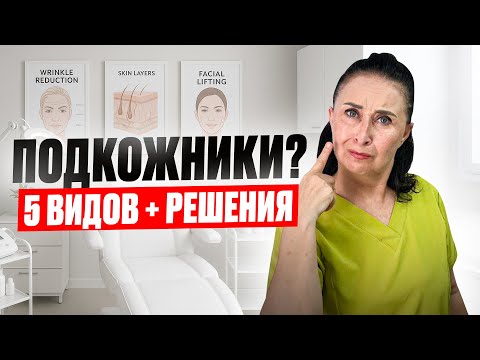 Видео: 😱 ПОДКОЖНИКИ на лице ❌ | Что это и как избавиться 💆‍♀️ | 🔎 ТОП-5 причин и решений