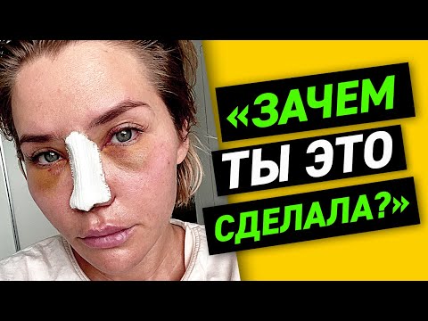 Видео: ЗАЧЕМ ТЫ ЭТО СДЕЛАЛА? | Моя ринопластика