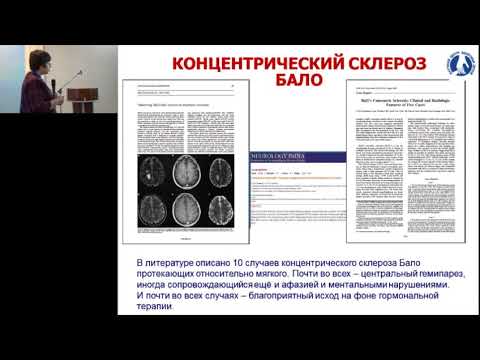 Видео: 19.02.2017 - Дифференциальный диагноз и направления лечения рассеянного склероза. Иммунотерапия.