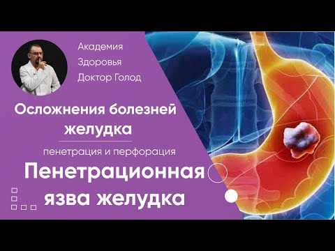 Видео: Пенетрация и перфорация - осложнения болезней желудка