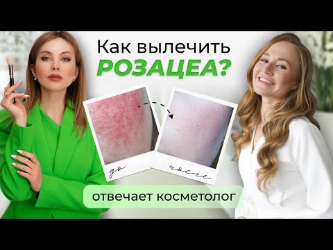 Видео: УХОД ЗА КОЖЕЙ ПРИ РОЗАЦЕА