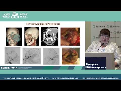 Видео: Рентгенэндоваскулярные вмешательства при опухолевых кровотечениях (Суворова Ю.В.)