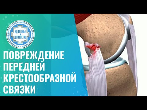 Видео: ❌​ Повреждение передней крестообразной связки и нестабильность суставов