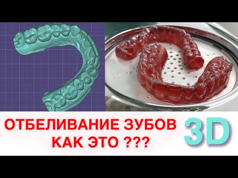 Видео: Каппы для домашнего отбеливания зубов 3d печать в стоматологии