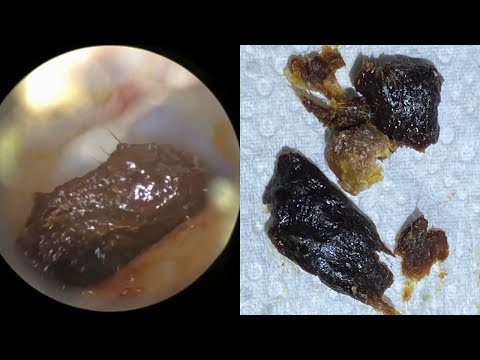 Видео: 146 - WAXscope®️ Удаление тонн темной ушной серы, обволакивающей омертвевшую кожу