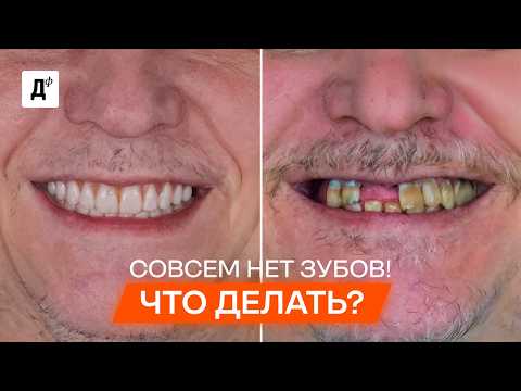Видео: НЕТ зубов? НЕ СТАВЬТЕ импланты, пока не посмотрите это видео!