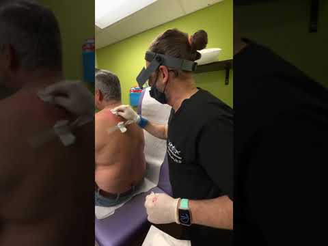 Видео: Массивное иссечение кисты и дренирование в клинике Las Vegas Dermatology® у доктора Вегаса — докт...