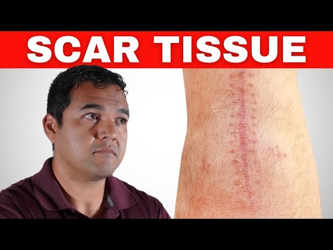 Видео: Как разрушить болезненную рубцовую ткань, чтобы ускорить заживление после замены коленного сустава