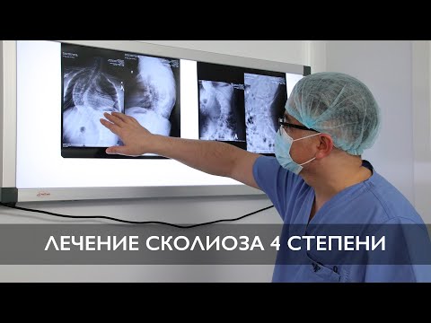 Видео: Лечение сколиоза 4 степени | Хирургическая коррекция | Отзыв