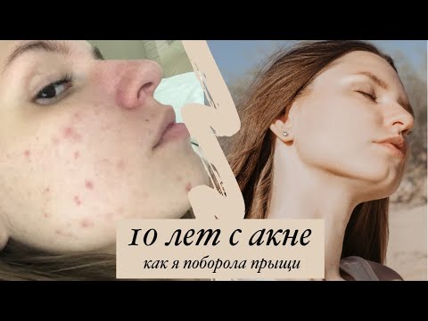 Видео: КАК Я ИЗБАВИЛАСЬ ОТ ПРЫЩЕЙ | как убрать пигментные пятна и постакне | средства от прыщей и постакне
