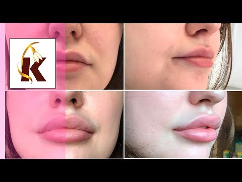 Видео: Увеличение губ - максимальный объем 3ml